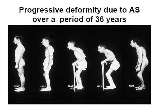 Spondylitis