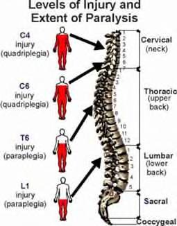 Paralysis